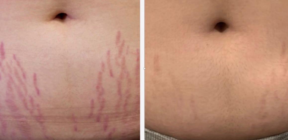 Scar Smooth, gladder van structuur en gecamoufleerd in kleur.
