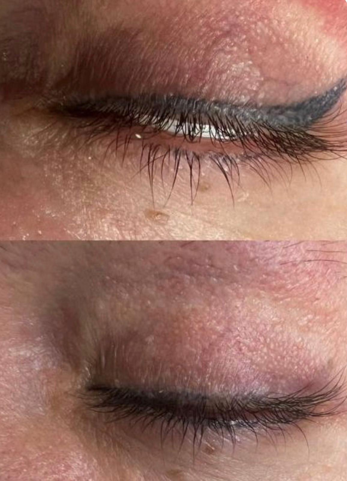 Resultaat na non laser PMU removal