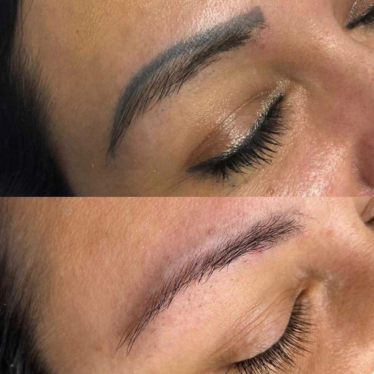 Lippen voor non laser PMU removal